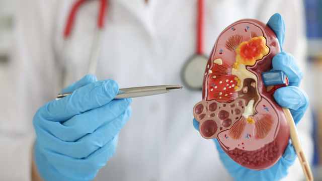 7 Gejala Batu Ginjal yang Jarang Diketahui Banyak Orang, Bahaya Jika Terlambat!