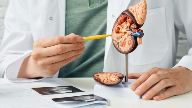 Cara Mengobati Batu Ginjal Dengan Efektif Dan Benar Menurut Pakar Kesehatan