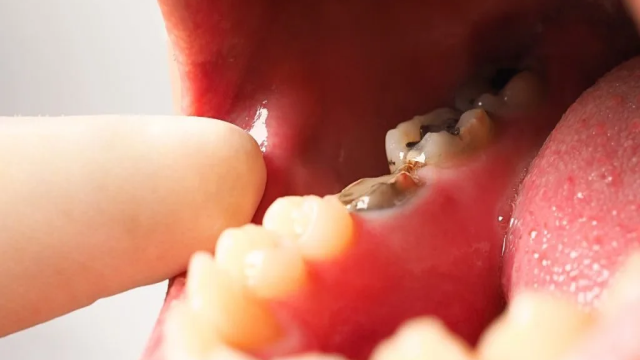 6 Penyebab Gigi Berlubang yang Sering Tidak Disadari Banyak Orang